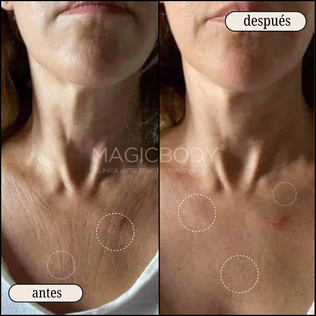 MagicBody™️ | Adiós Piel Suelta!, Sin Clínicas Ni Agujas