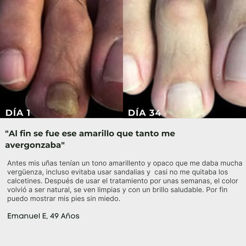 ByeFungus | Elimina los hongos de raíz