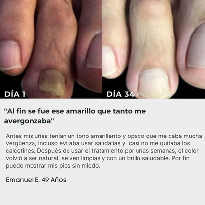 ByeFungus | Elimina los hongos de raíz